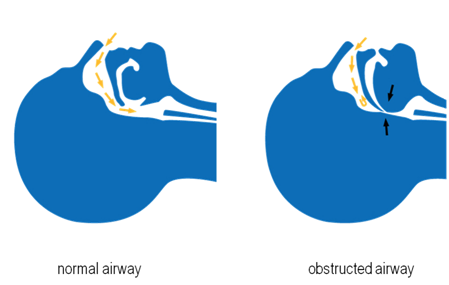 The-3-Types-of-Sleep-Apnea